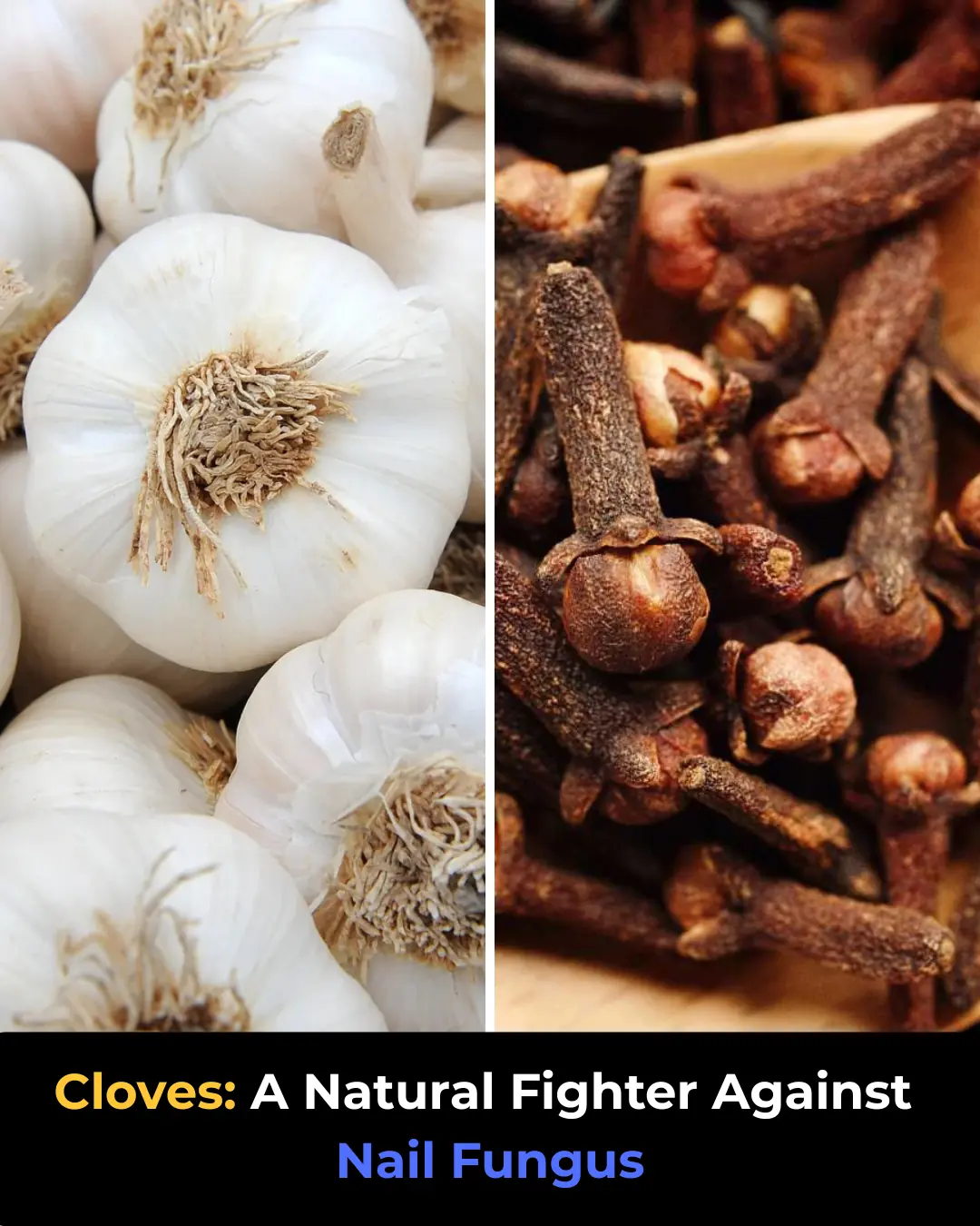 Cloves to Eliminate Nail Fungus Naturally