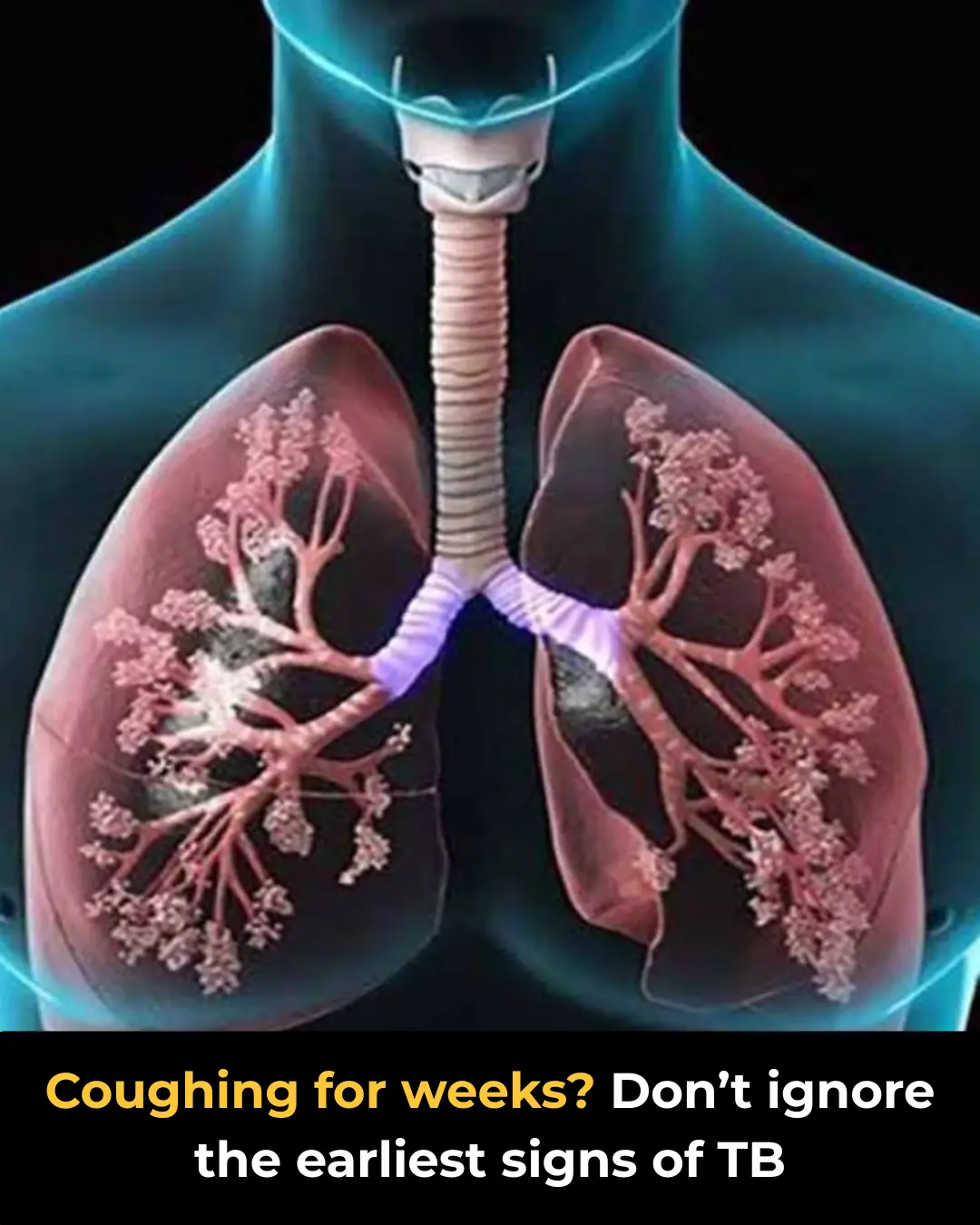 Tuberculosis Symptoms: What You Need to Know Early