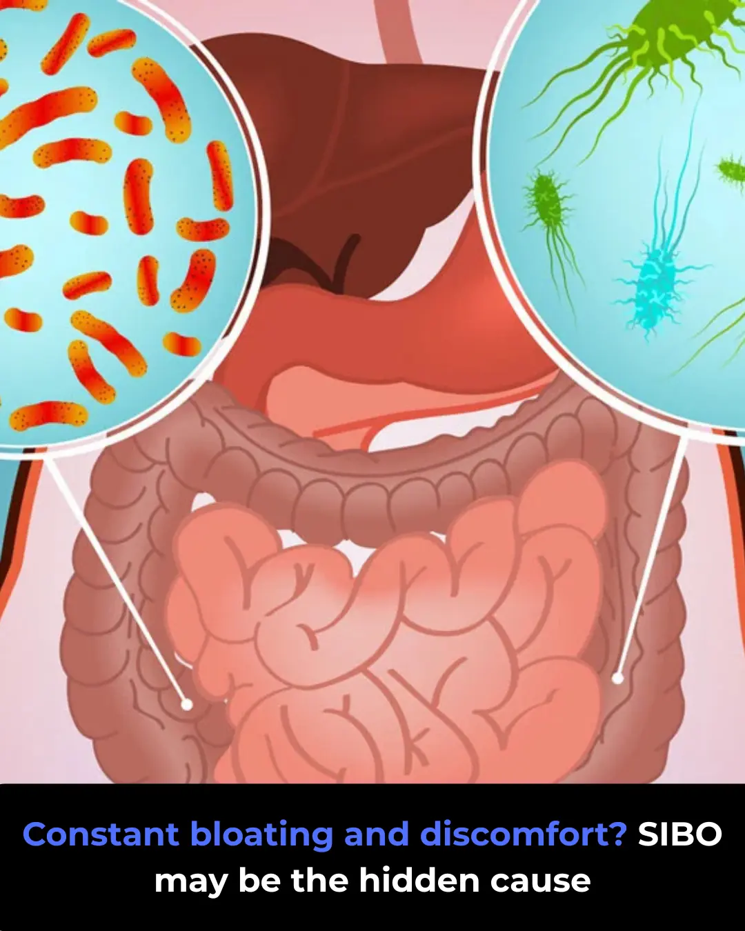 Small Intestinal Bacterial Overgrowth (SIBO): Signs to Watch