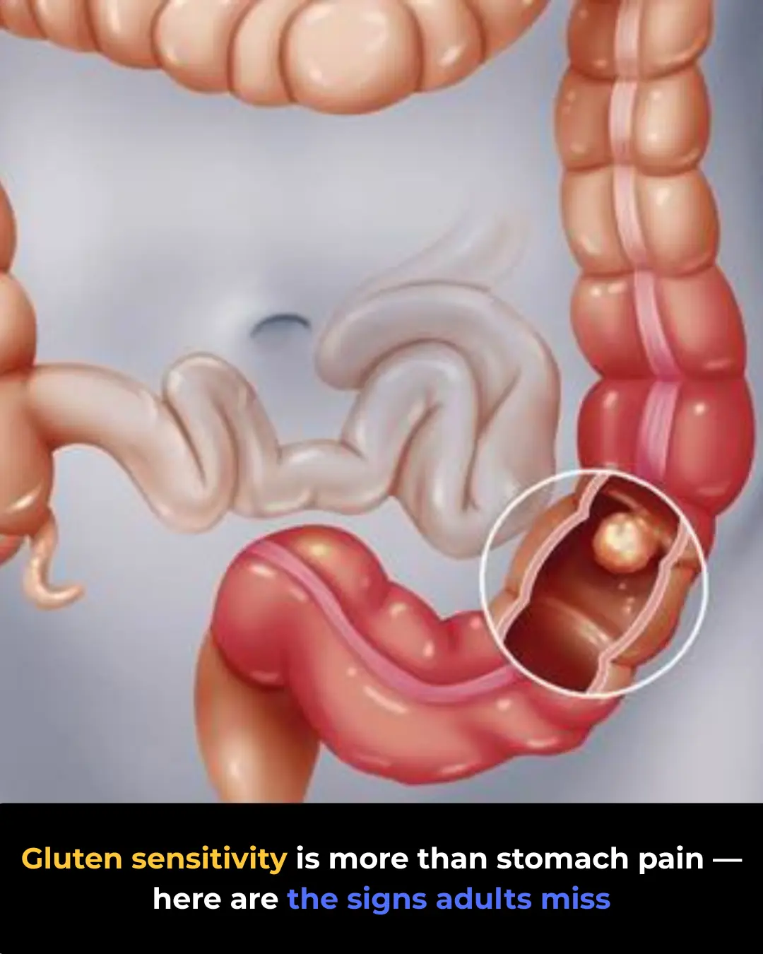 Celiac Disease: Symptoms Most Adults Don’t Recognize