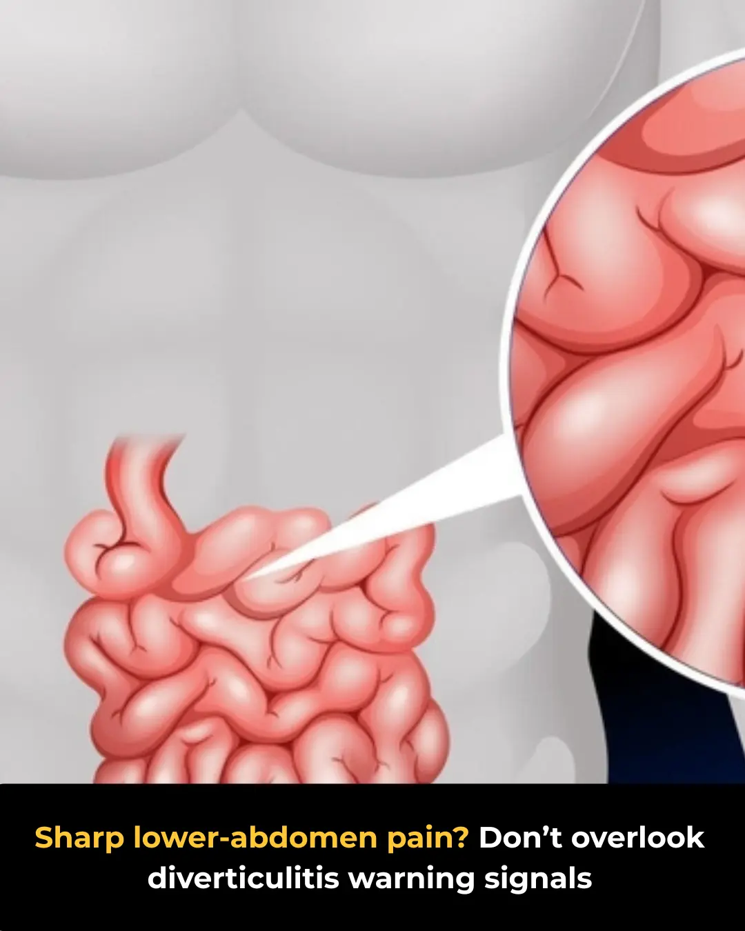 Diverticulitis: Pain Patterns and Treatment Guidelines