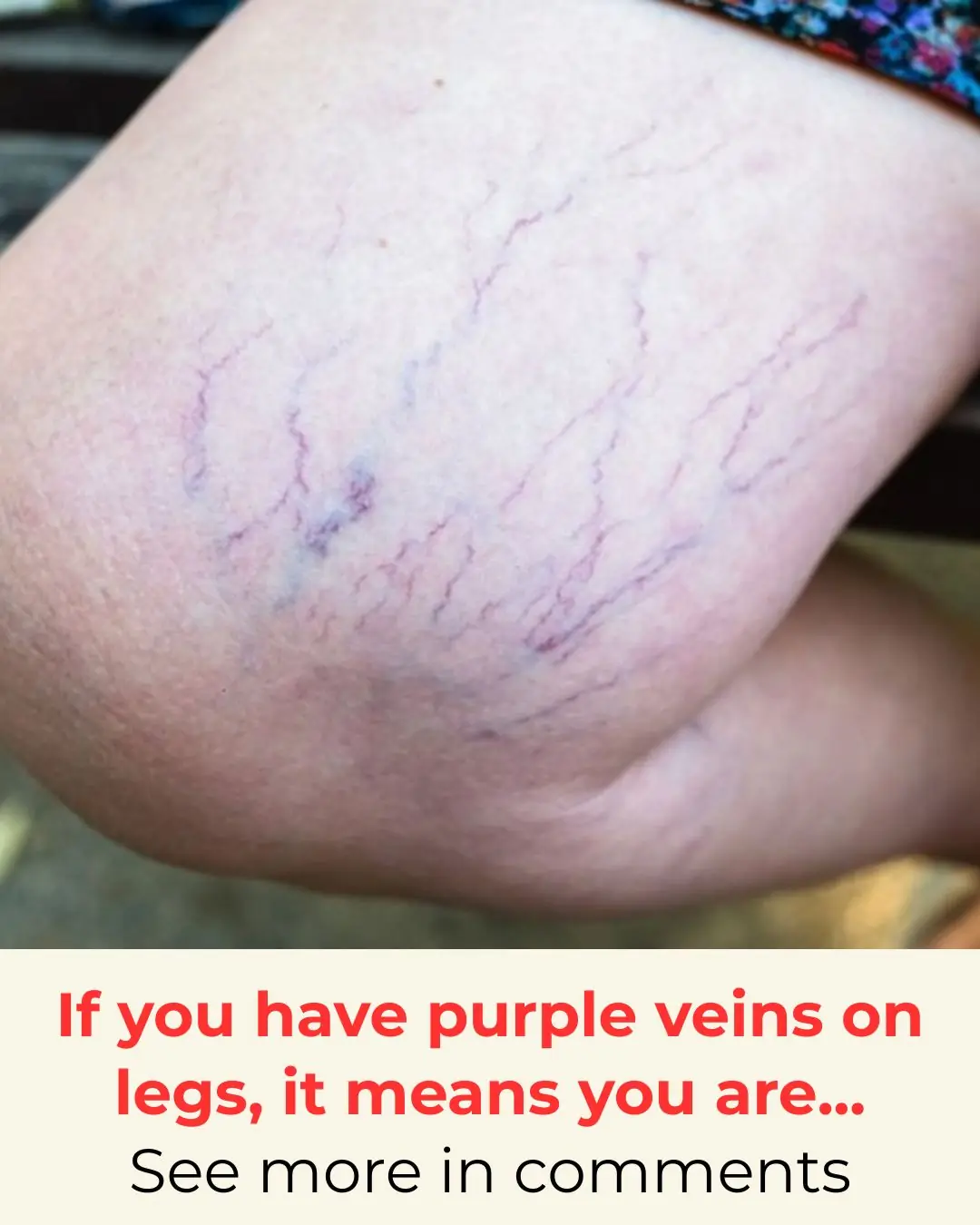 Purple Veins on Your Legs