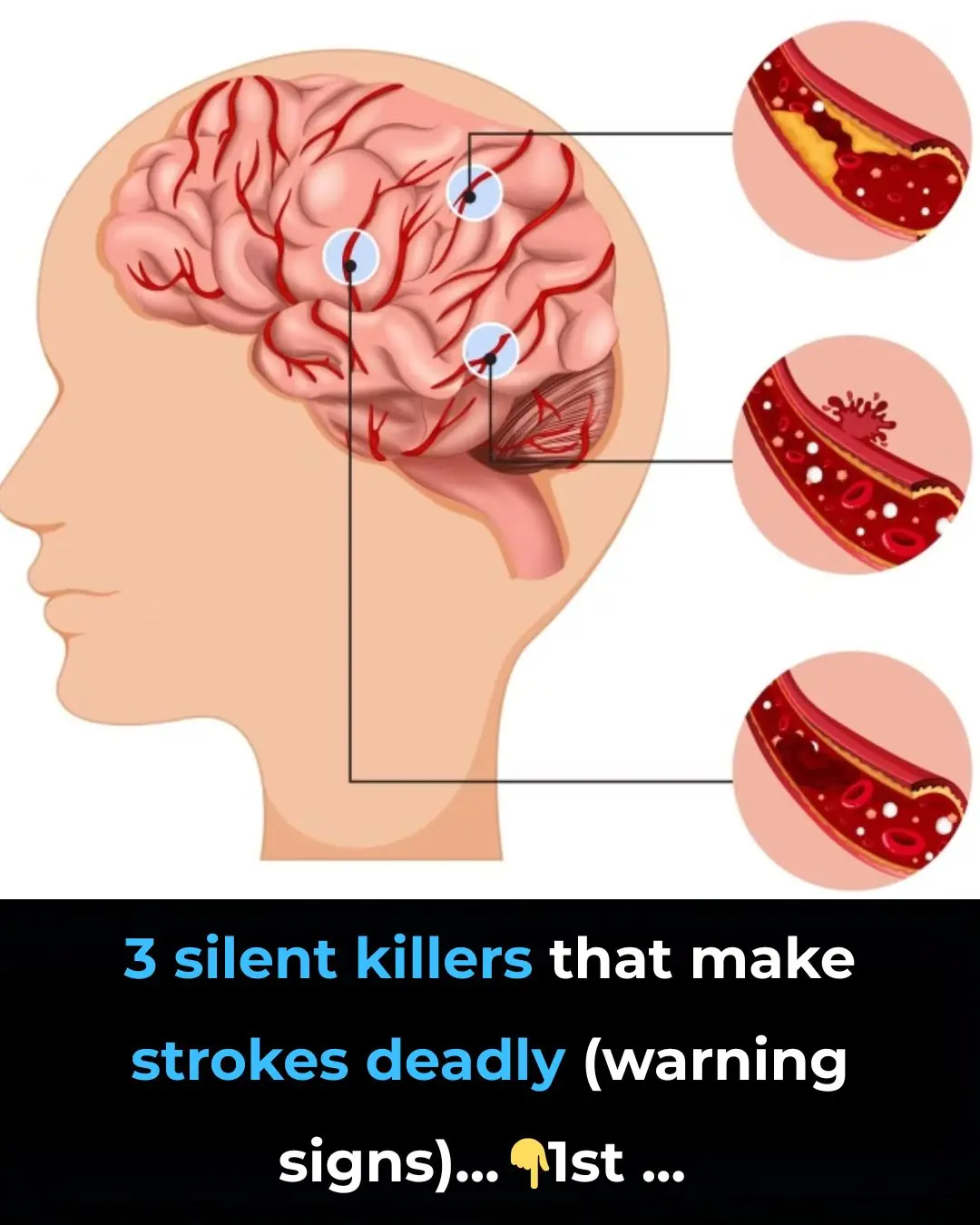 3 silent killers that make strokes deadly (warning signs)