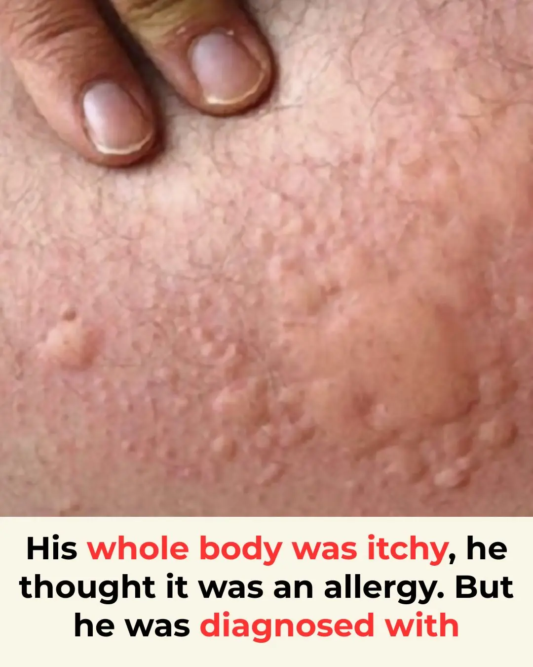 His whole body was itchy, he thought it was an allergy but then he was diagnosed