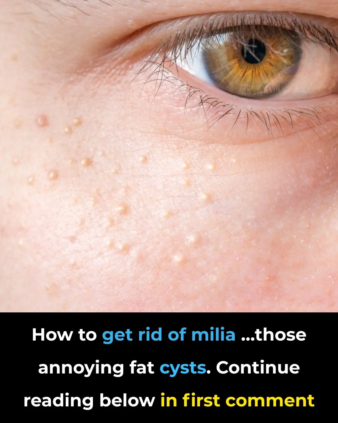 How to Get Rid of Milia