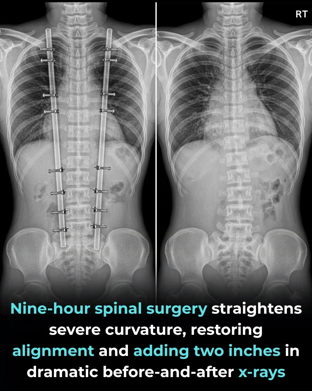 A Life-Changing Spinal Surgery Restores Health and Confidence