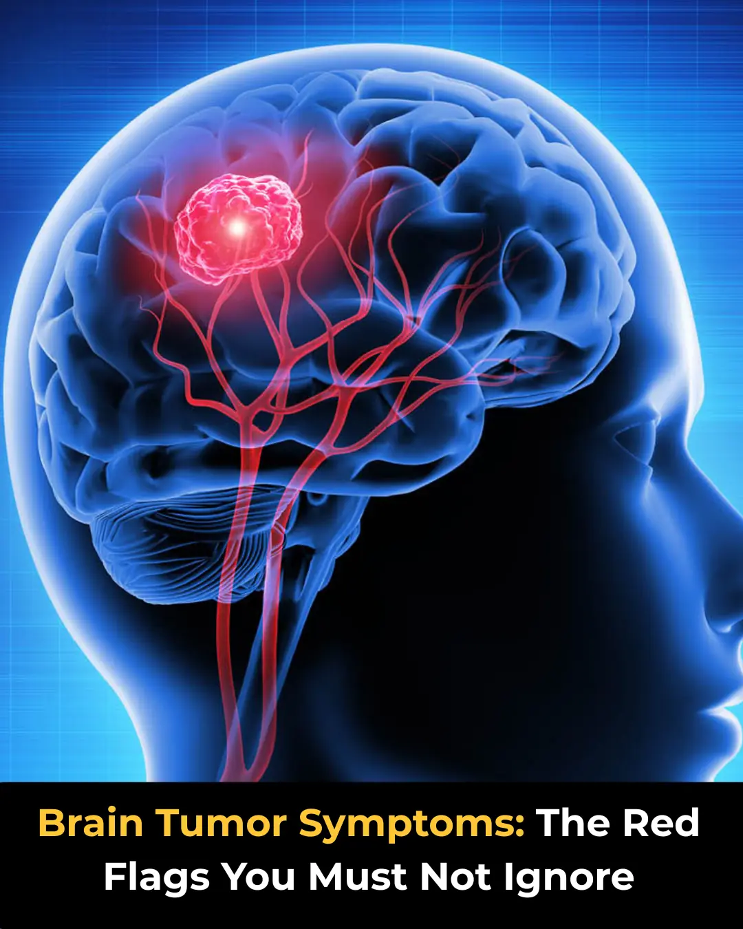 Brain Tumor Symptoms: The Red Flags You Must Not Ignore