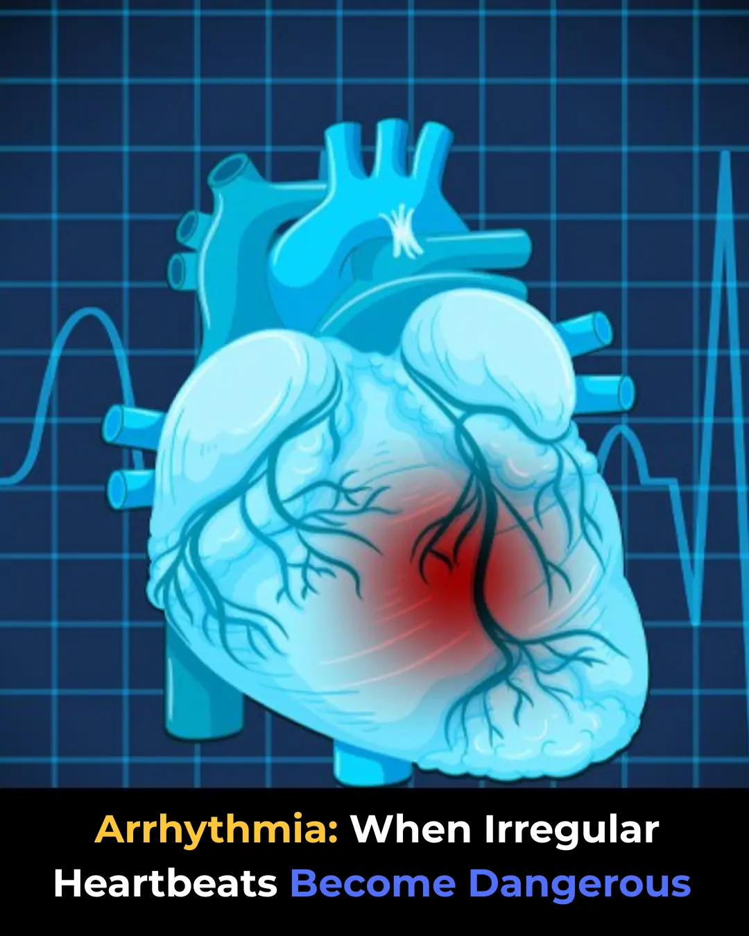 Arrhythmia: When Irregular Heartbeats Become Dangerous