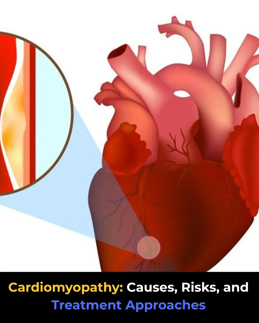 Cardiomyopathy: Causes, Risks, and Treatment Approaches