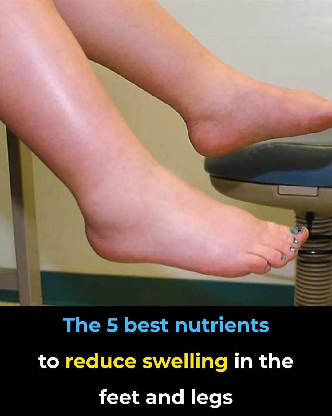 đŠ” The 5 Best Nutrients to Reduce Swelling in the Feet and Legs