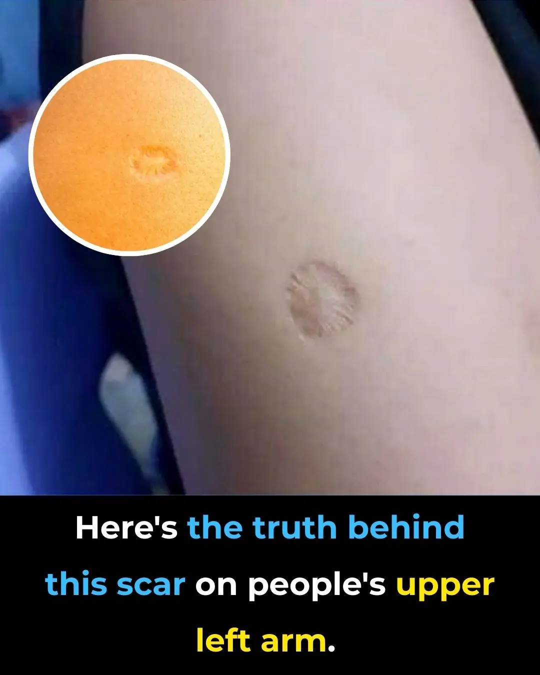 Here's The Truth Behind This Scar On People's Upper Left Arm