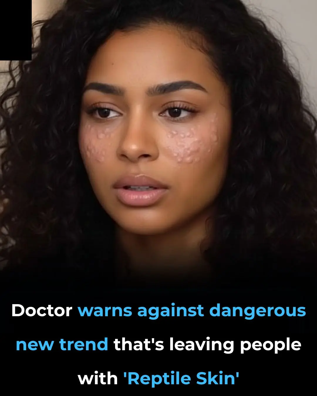 Doctor Warns of Mesotherapyâs Risky Side, Causing Reptile-Like Skin