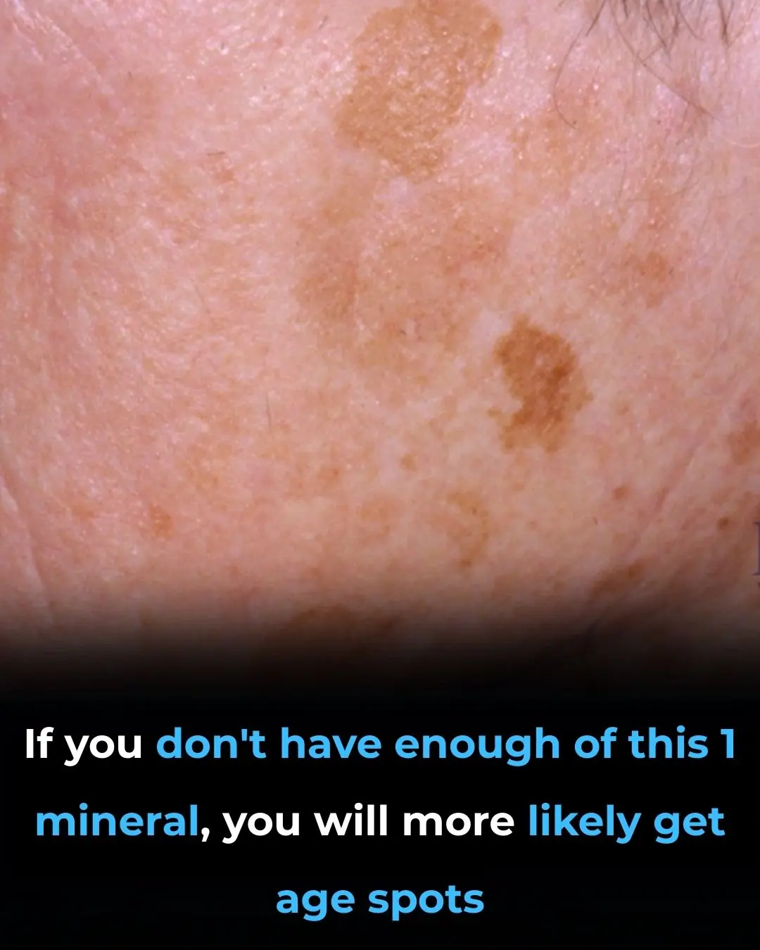 The Number One Deficiency Behind Aging Spots