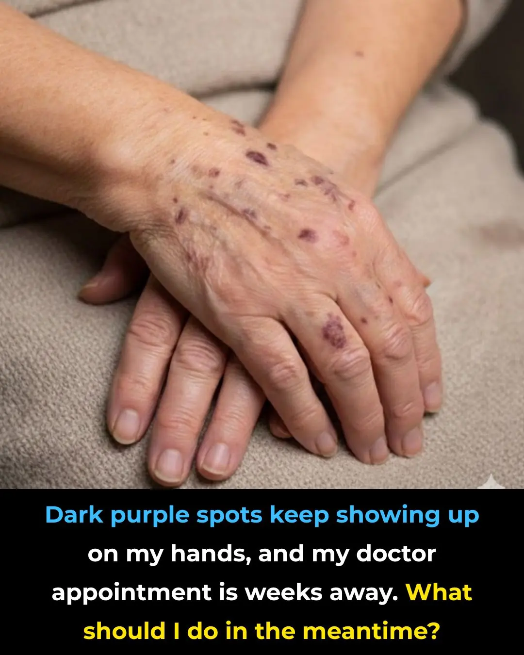 Dark Purple Spots Keep Showing Up on Your Hands? Here’s What to Do While You Wait to See a Doctor