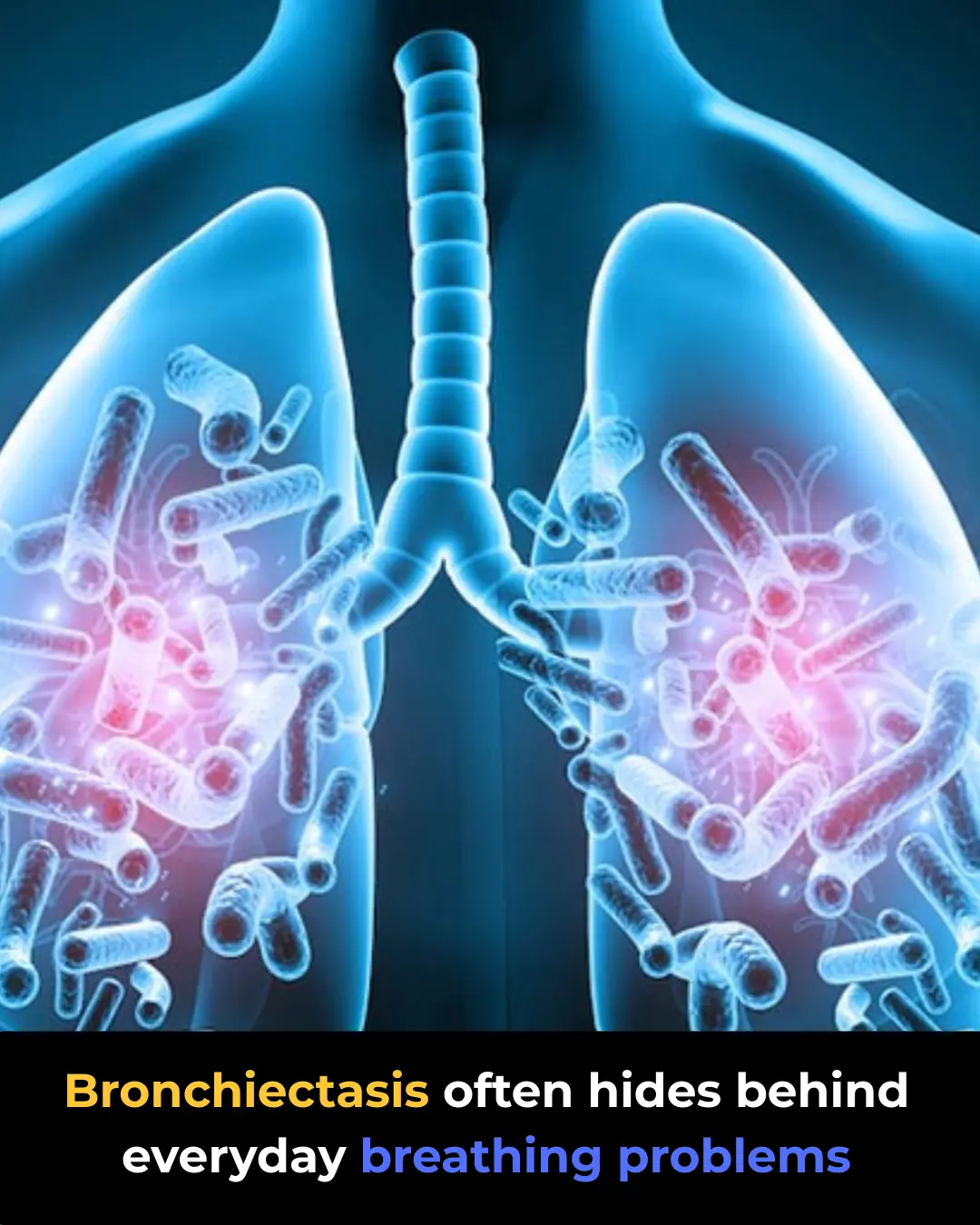 Bronchiectasis: Symptoms Most People Overlook