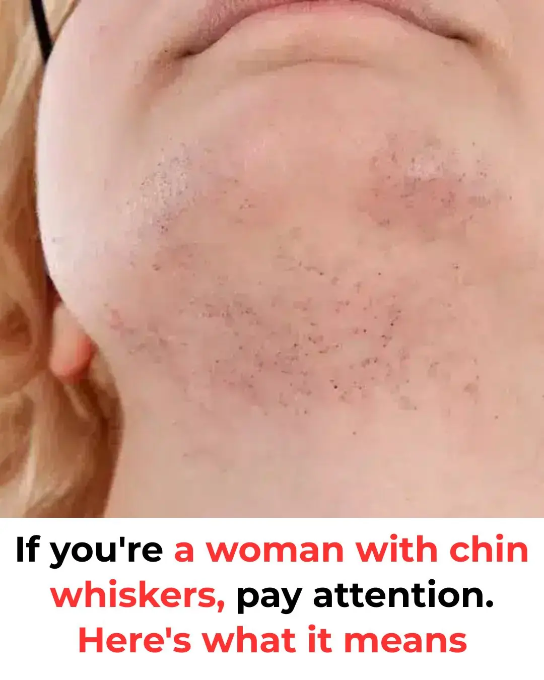 Chin Whiskers in Women