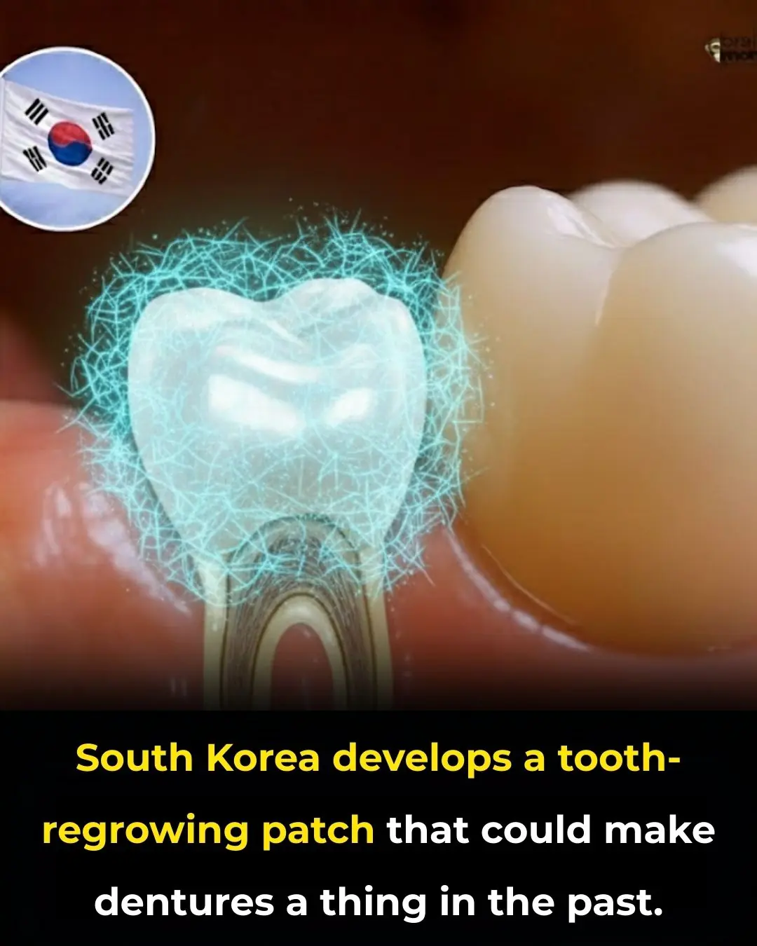 Revolutionary Microneedle Patch Offers Hope for Natural Tooth Regrowth