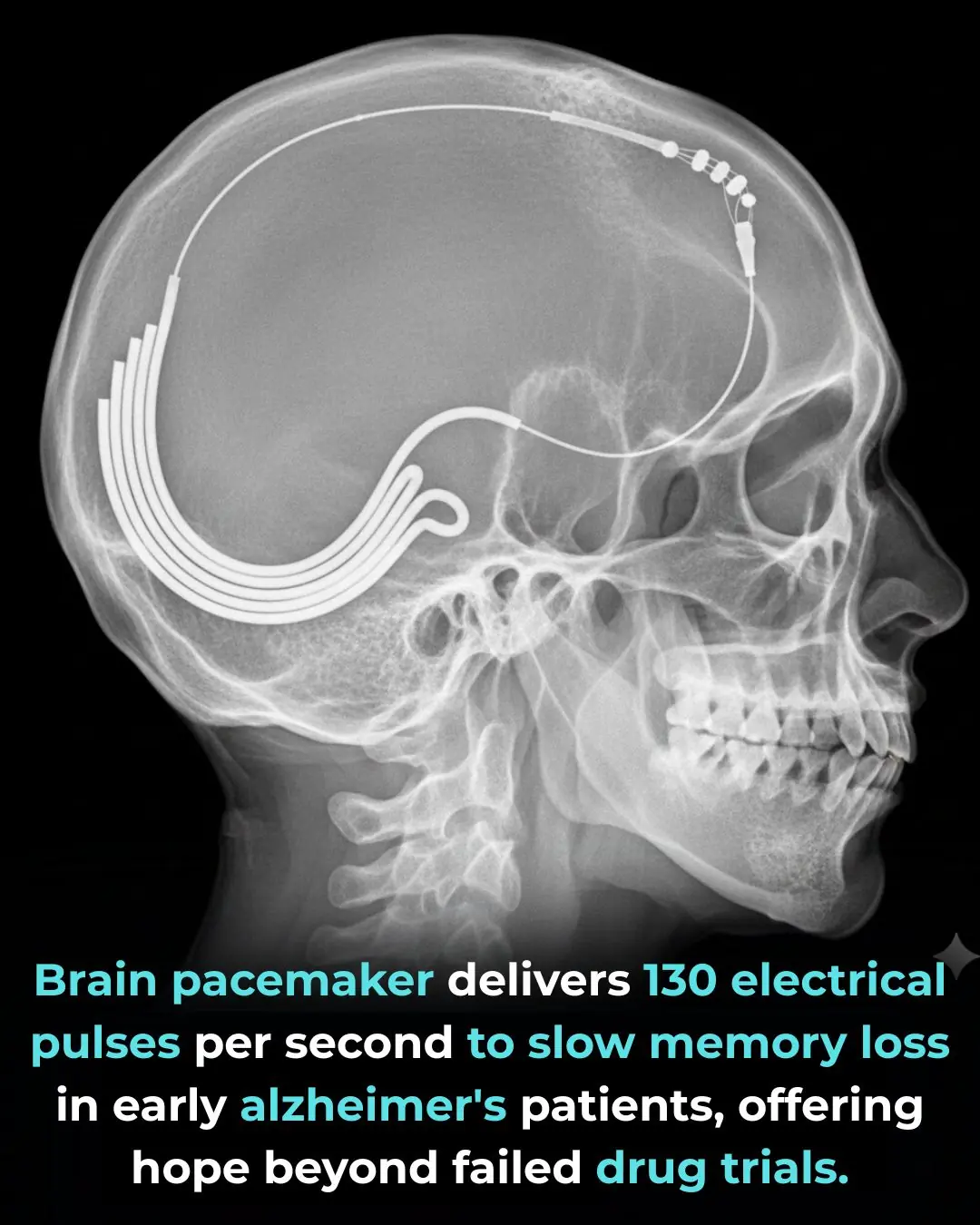 Brain Pacemakers and Alzheimer’s: How Deep Brain Stimulation Could Slow Memory Loss