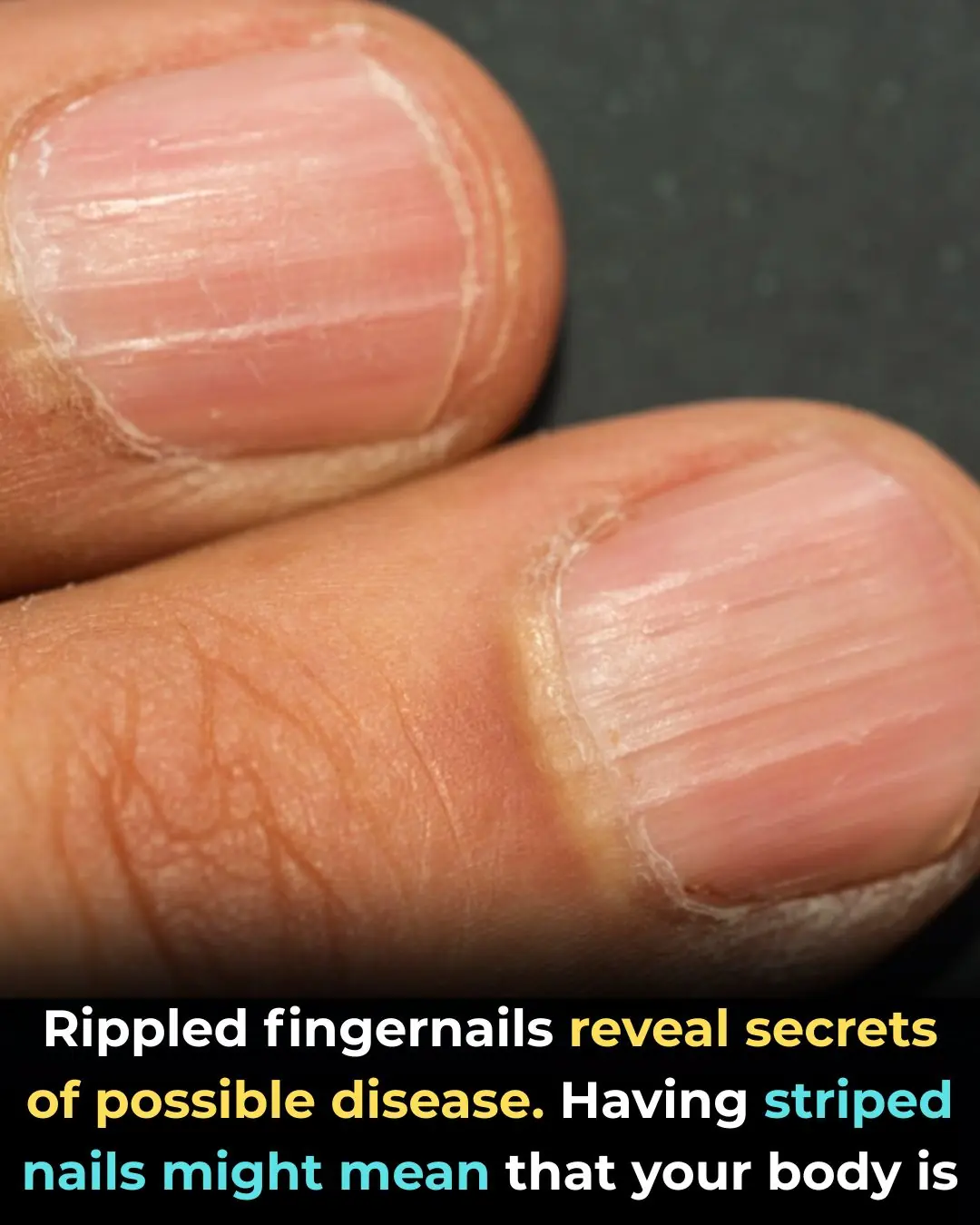 Rippled Fingernails Reveal Secrets Of Possible Disease