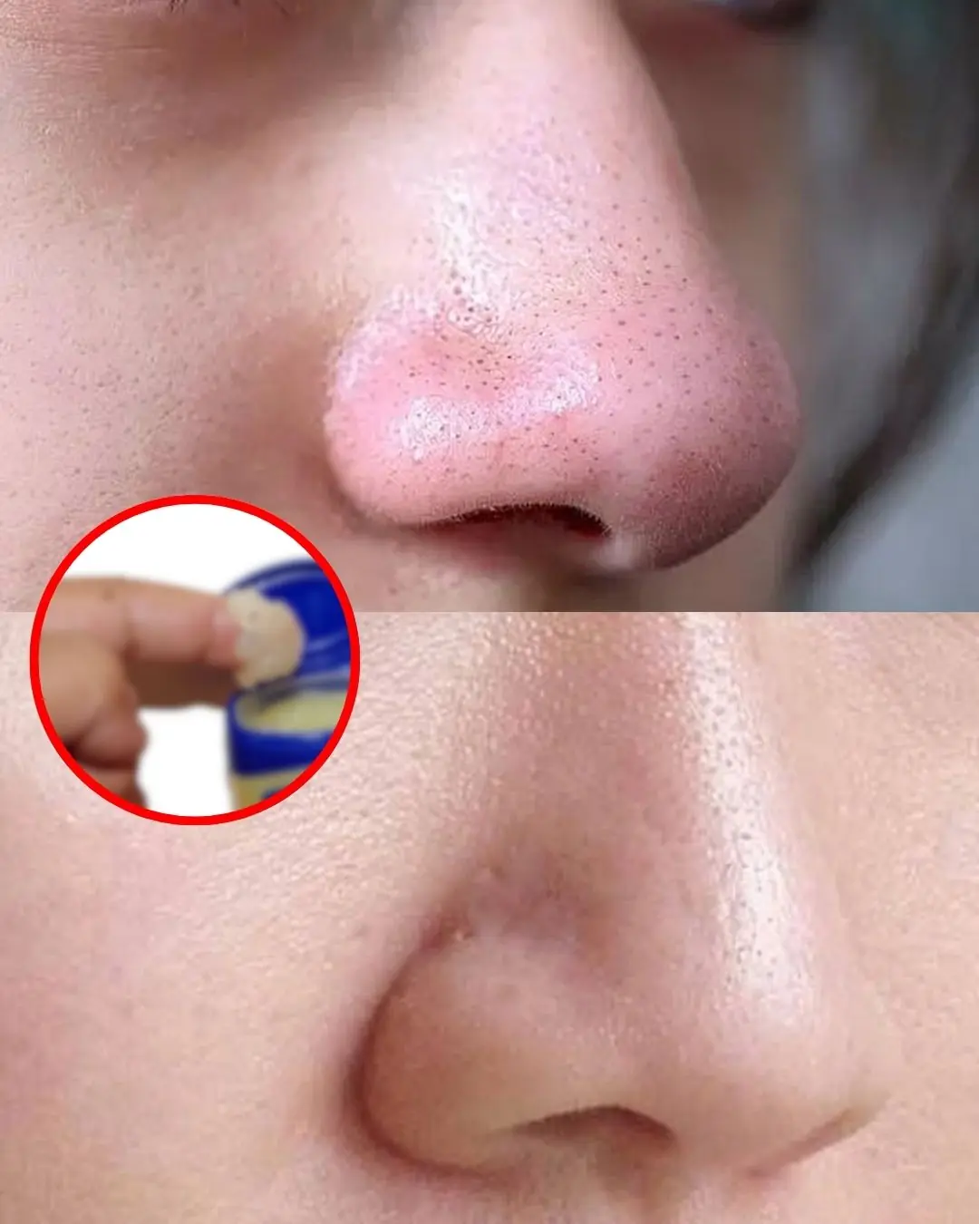 Remove Blackheads On Your Nose