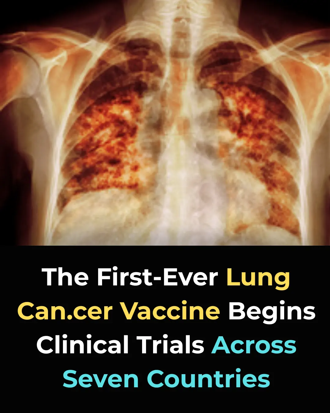 Revolutionary mRNA Lung Cancer Vaccine Begins Human Trials—A Breakthrough in Cancer Treatment