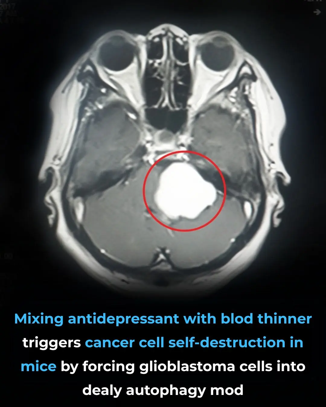 Scientists Trigger Cancer Cells to Destroy Themselves From the Inside Out