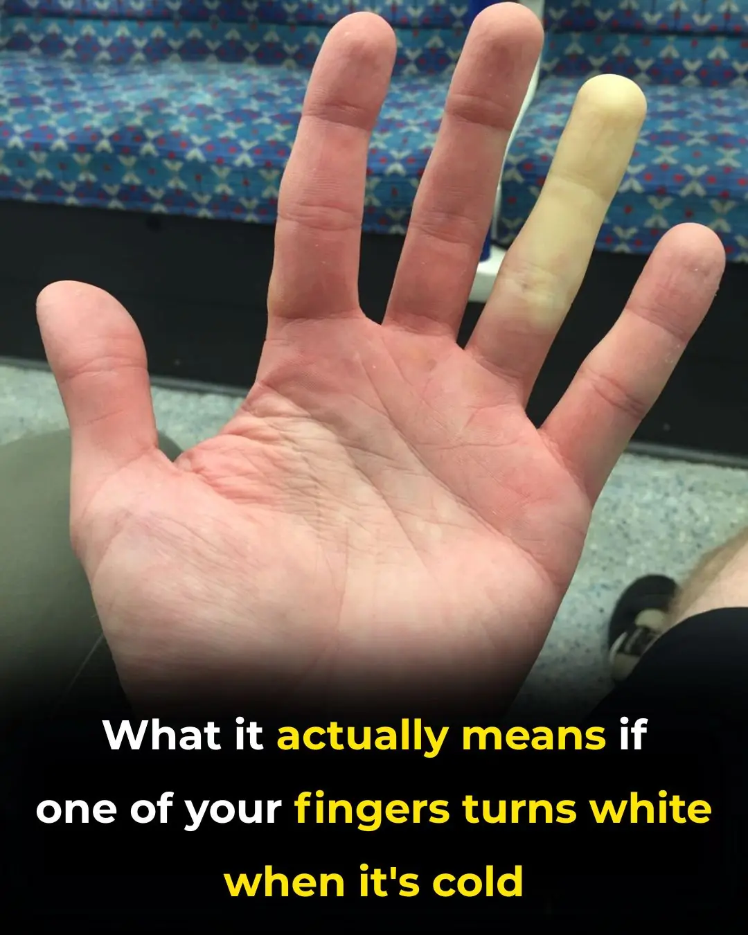 What It Means If Your Fingers Turn White When It’s Cold