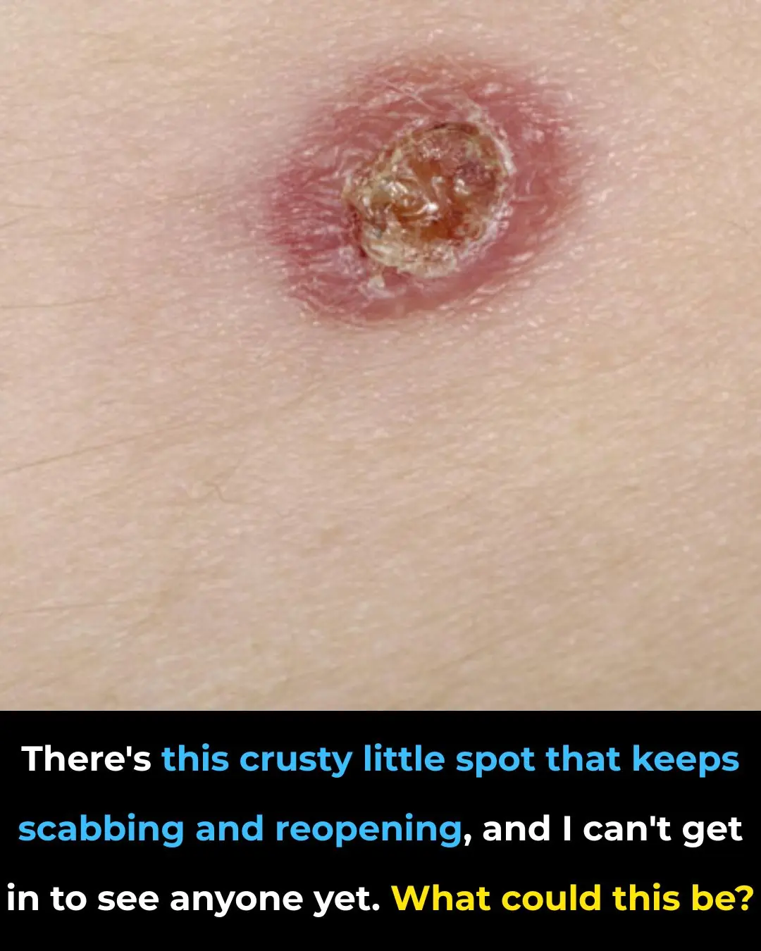 There’s a Crusty Spot That Keeps Scabbing and Reopening — What Could It Be?
