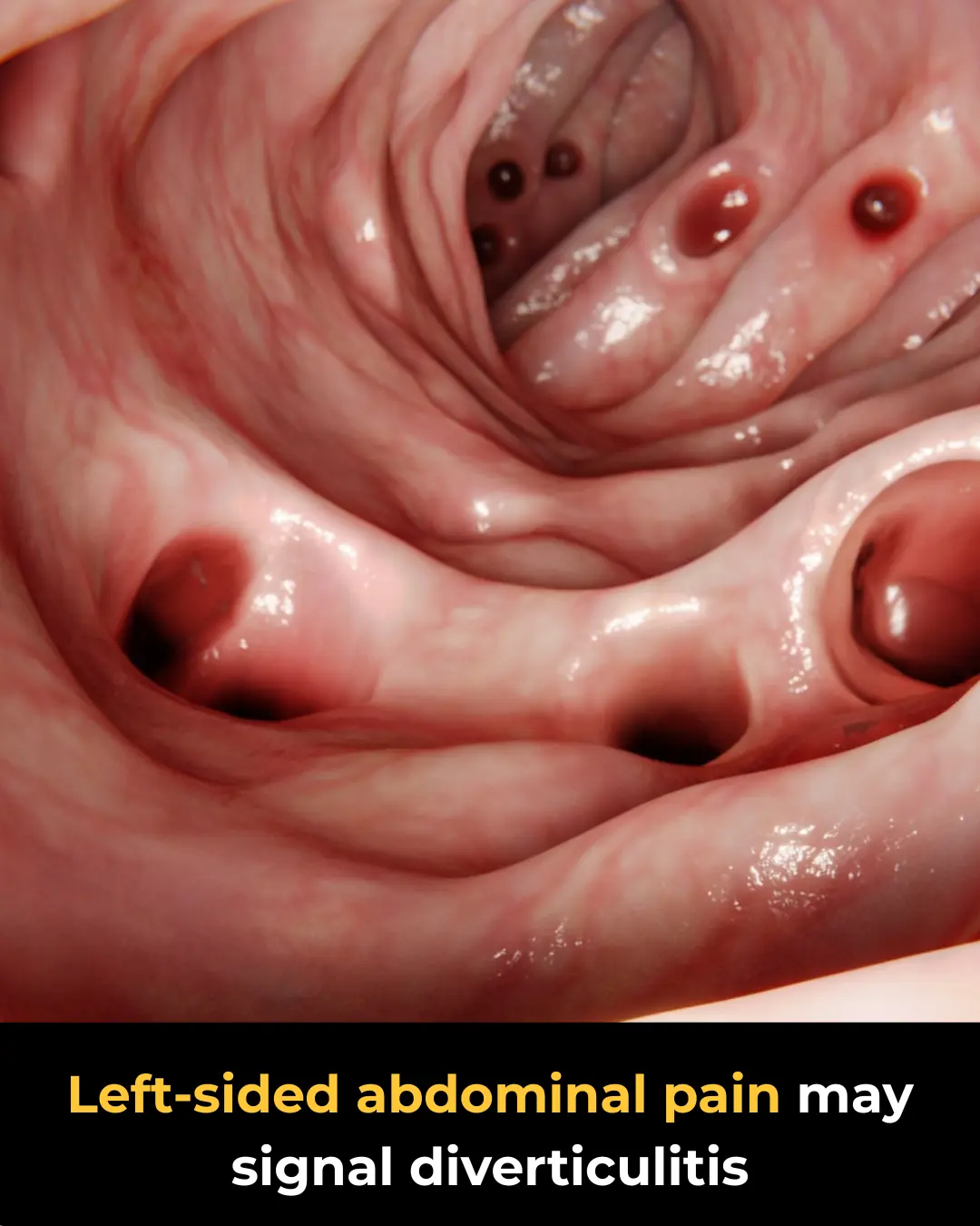 Diverticulitis: Pain Patterns and Treatment Guidelines