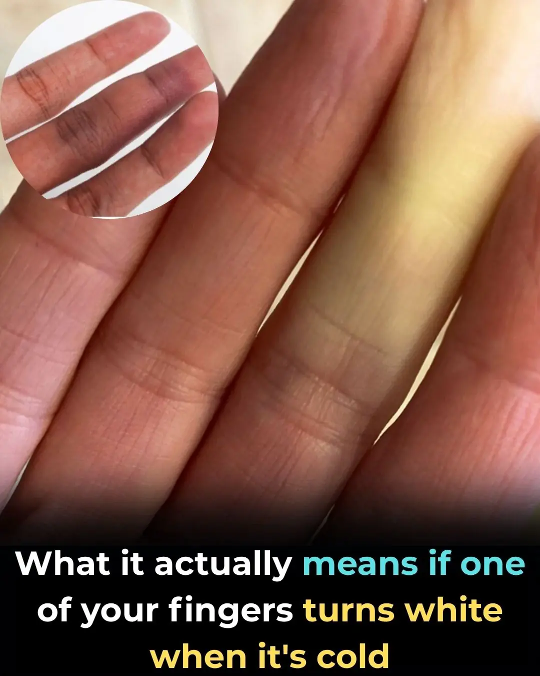 What It Means If Your Fingers Turn White When It’s Cold