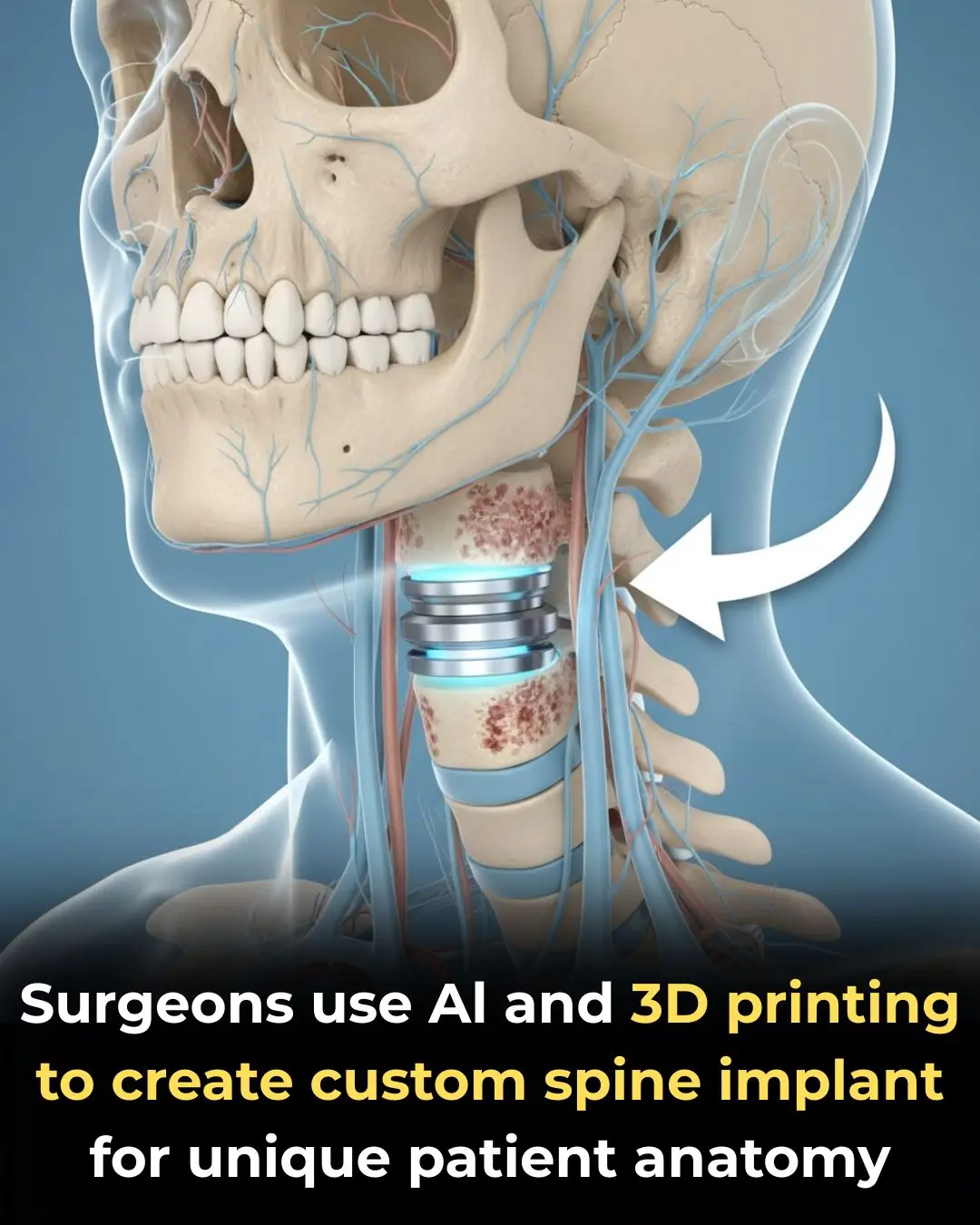 UC San Diego Health Performs World’s First Personalized Anterior Cervical Spine Surgery Using AI and 3D Printing