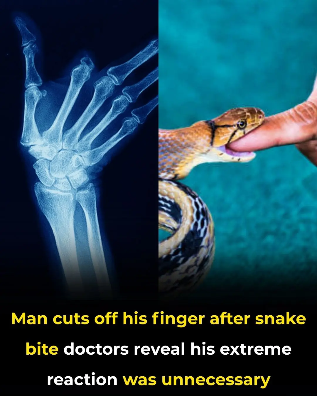 The Farmer Who Cut Off His Own Finger After a Snake Bite: A Tale of Panic and Misinformation