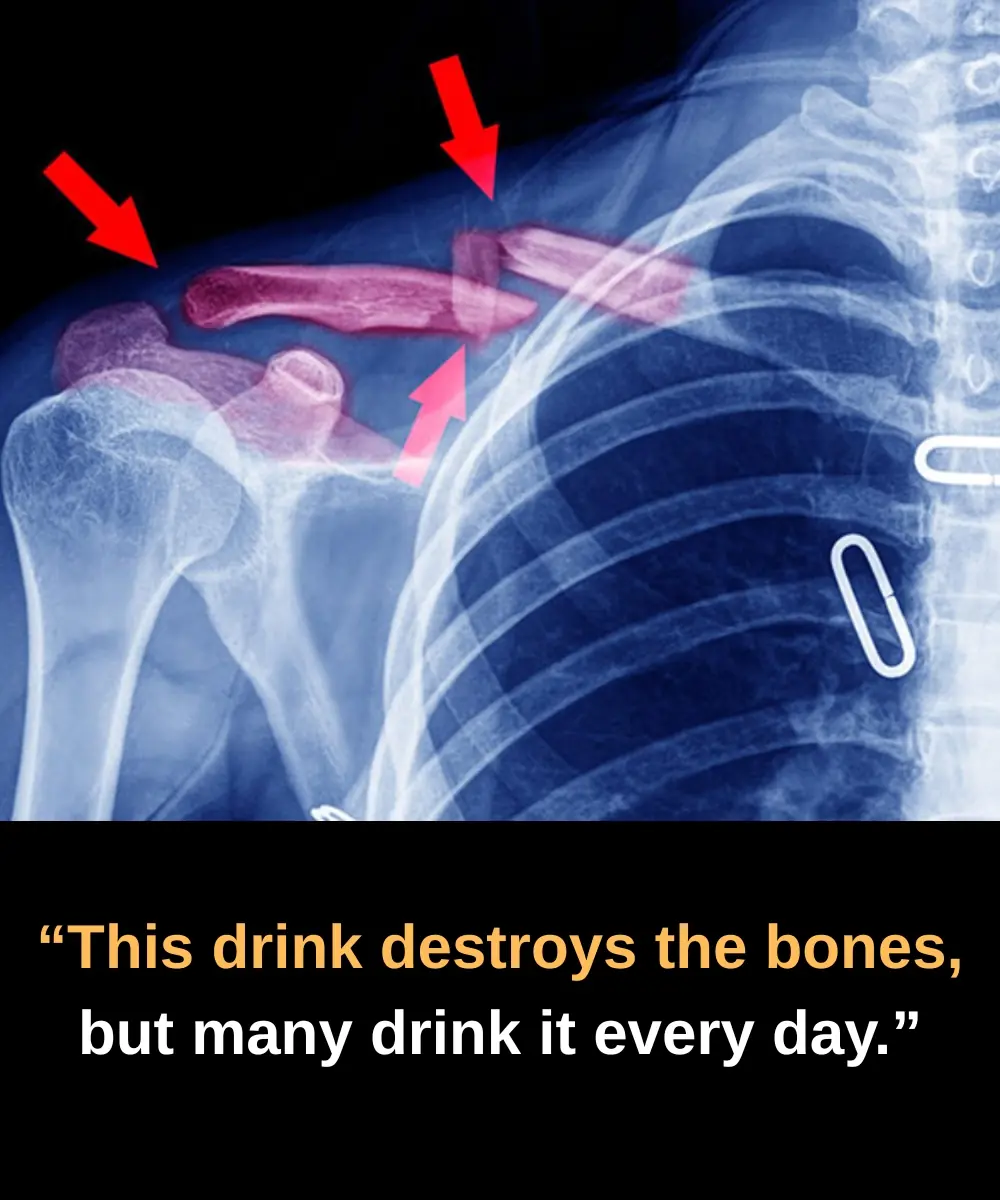 Does This Drink Really Harm Your Bones? The Truth Behind Soda and Your Health