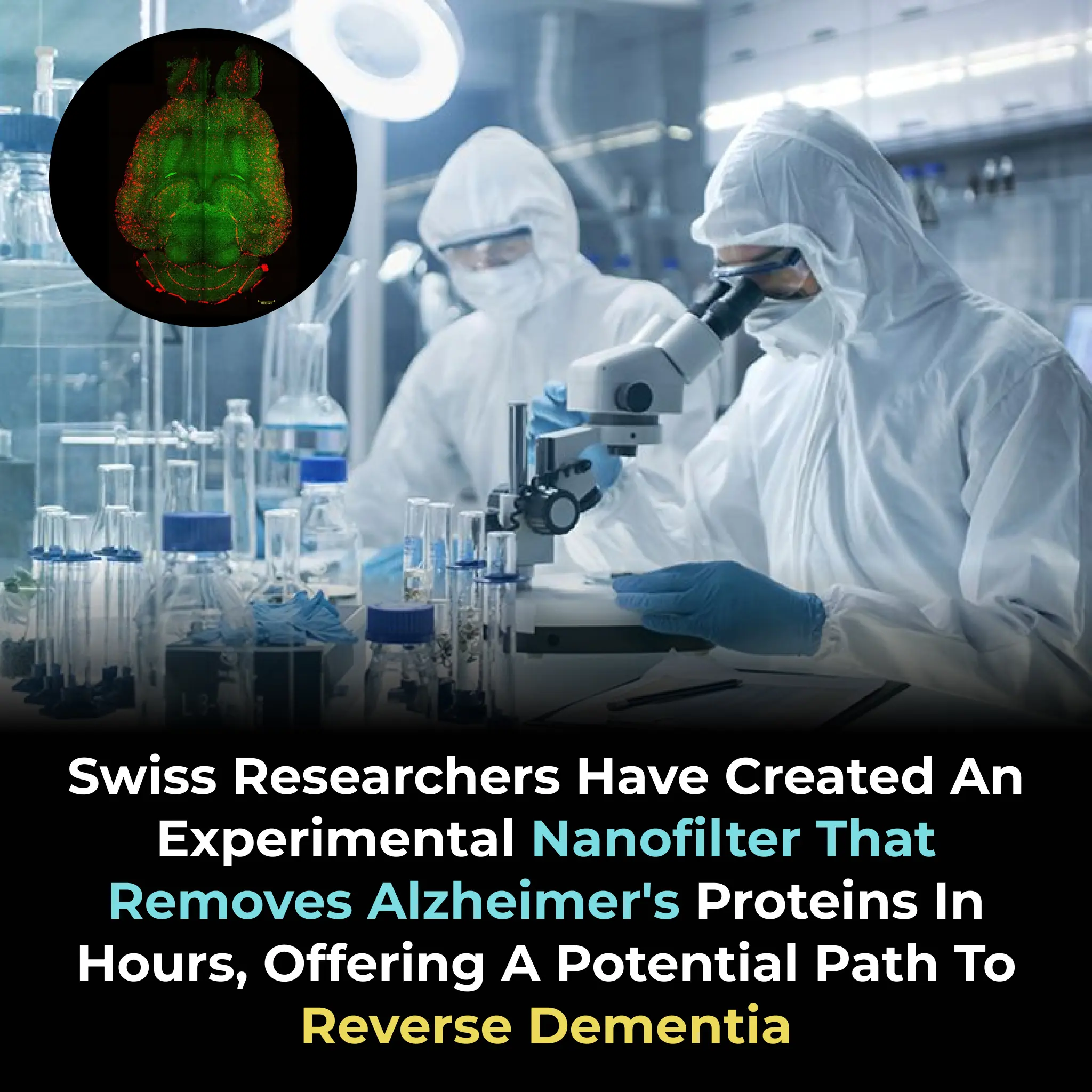 Swiss Researchers Trial Blood Filtration Device for Alzheimer's Treatment