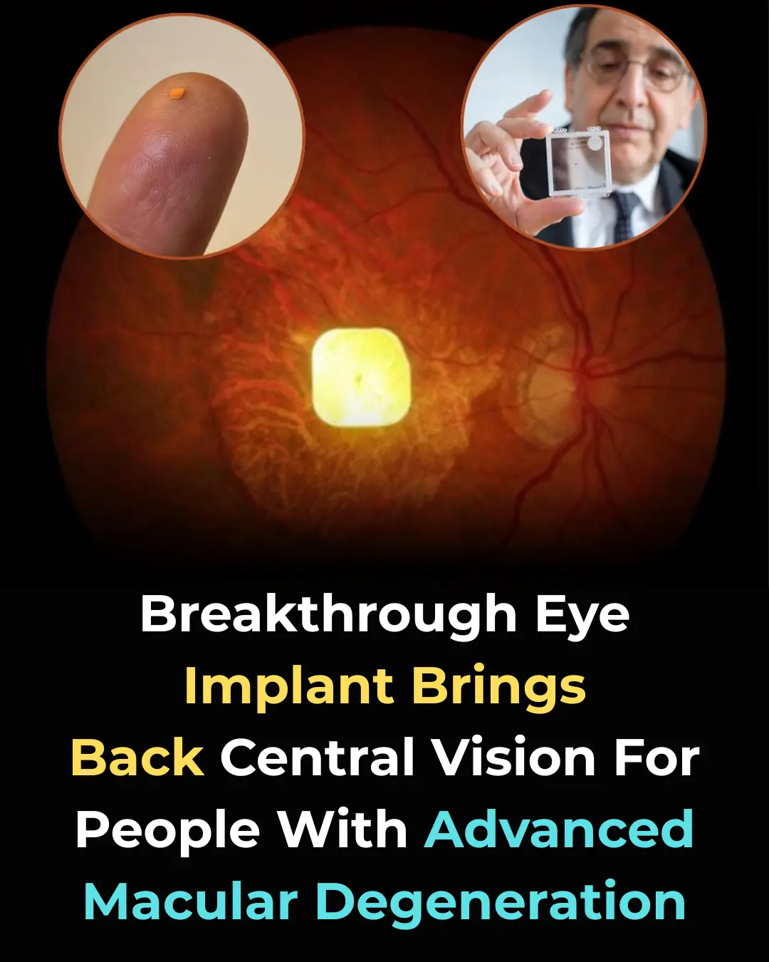 Revolutionary Eye Implant Restores Central Vision for Macular Degeneration Patients – A Game-Changer in Sight Restoration!