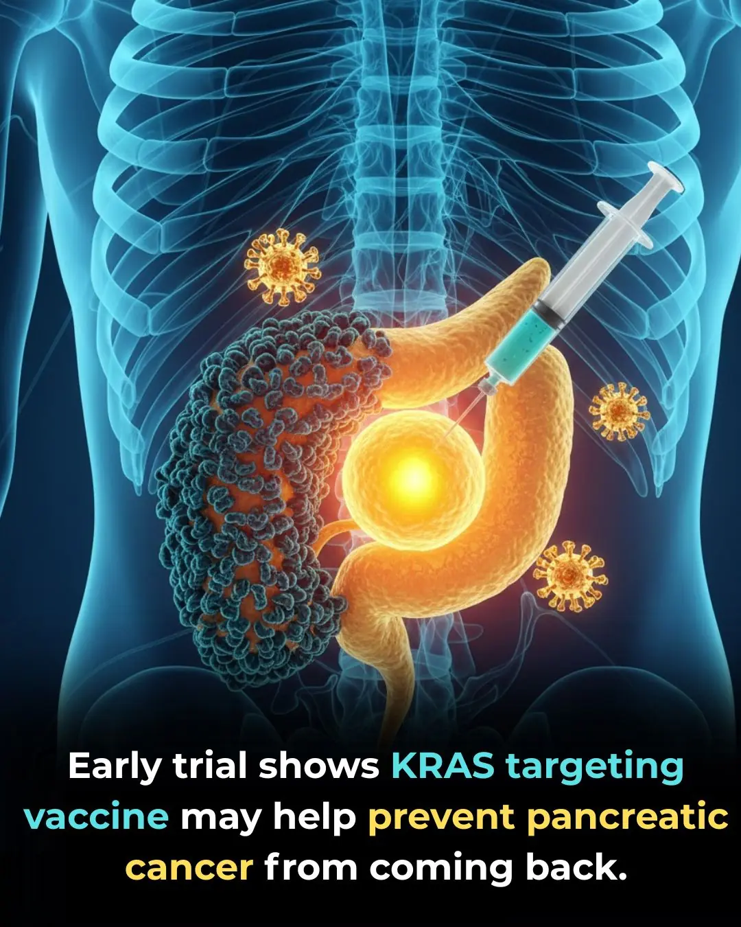 Promising Early-Phase Trial Suggests New KRAS-Targeted Vaccine Could Improve Outcomes in Pancreatic Cancer