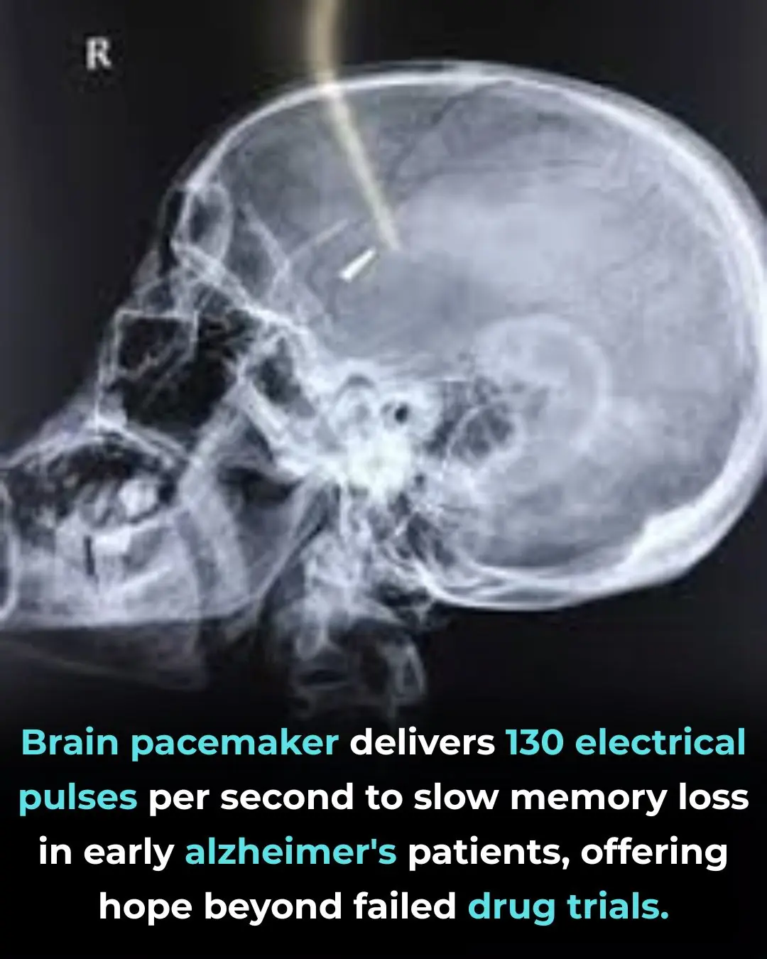 Johns Hopkins Medicine Pioneers ‘Brain Pacemaker’ to Combat Alzheimer’s and Preserve Memory Function