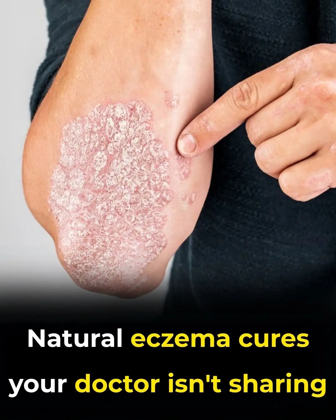 How To Get Rid Of Eczema: 13 Natural Remedies Backed By Research