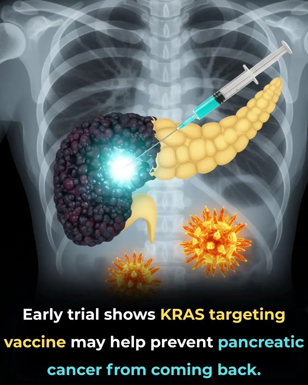 Study Finds Encouraging Immune Responses from Novel Pancreatic Cancer Vaccine