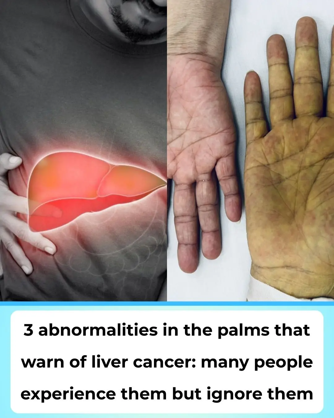 Three Unusual Hand Signs That May Warn of Liver Cancer