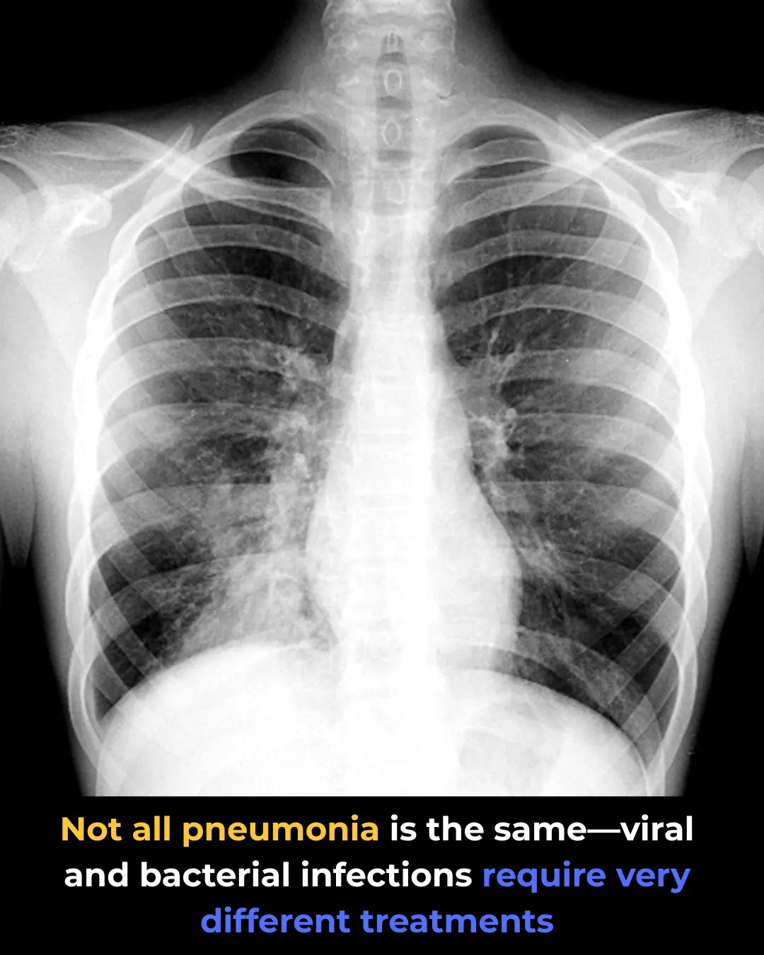 Viral Pneumonia vs. Bacterial Pneumonia: Key Differences