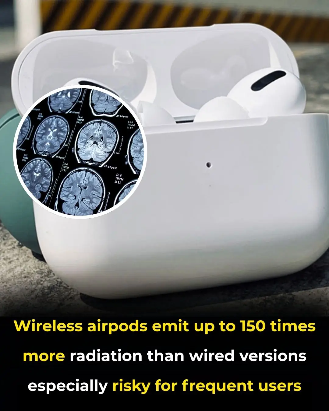 Study Highlights Health Risks of Prolonged Use of Wireless Earbuds: Radiation Concerns and Safety Tips