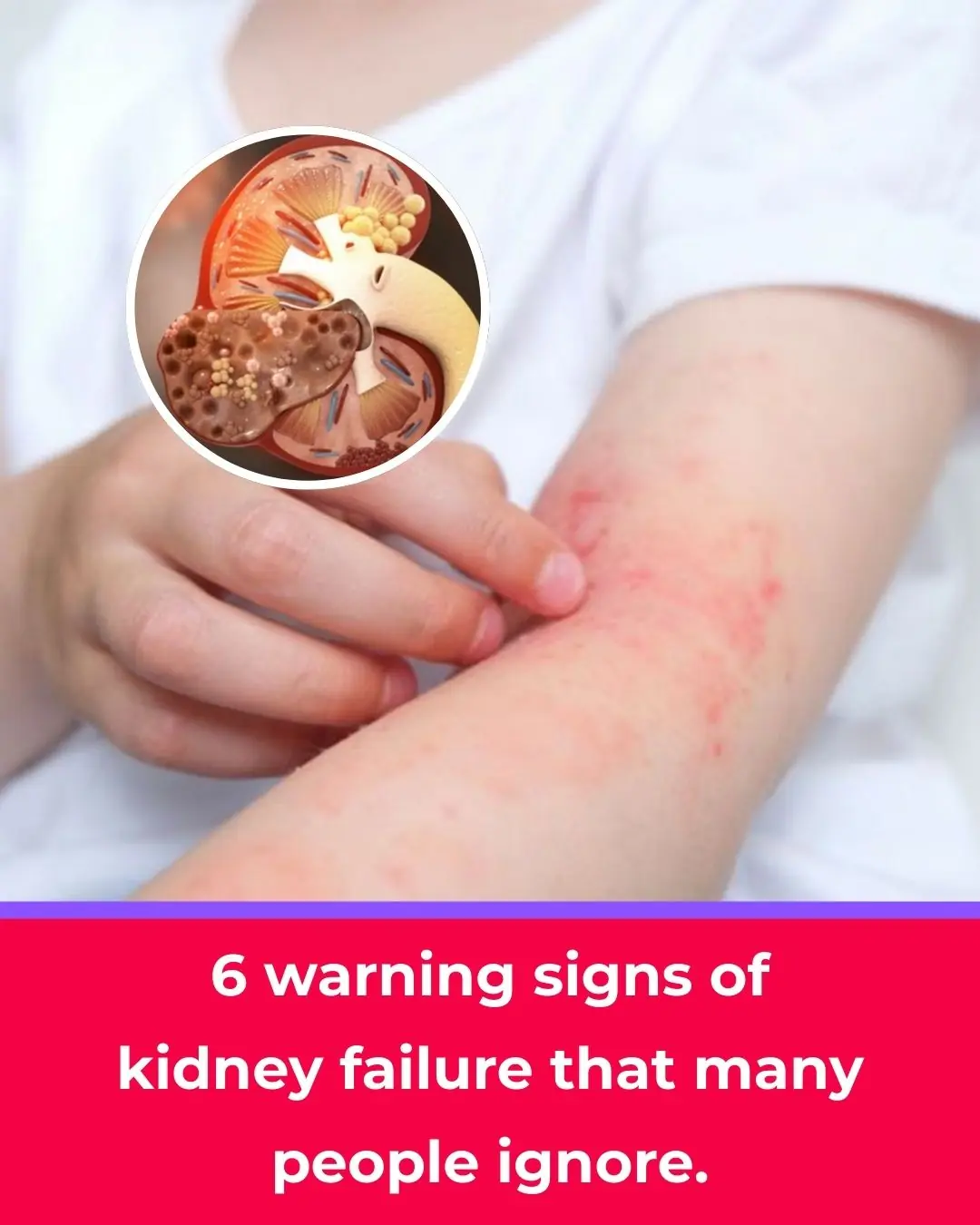 6 Warning Signs of Kidney Failure Many People Often Ignore
