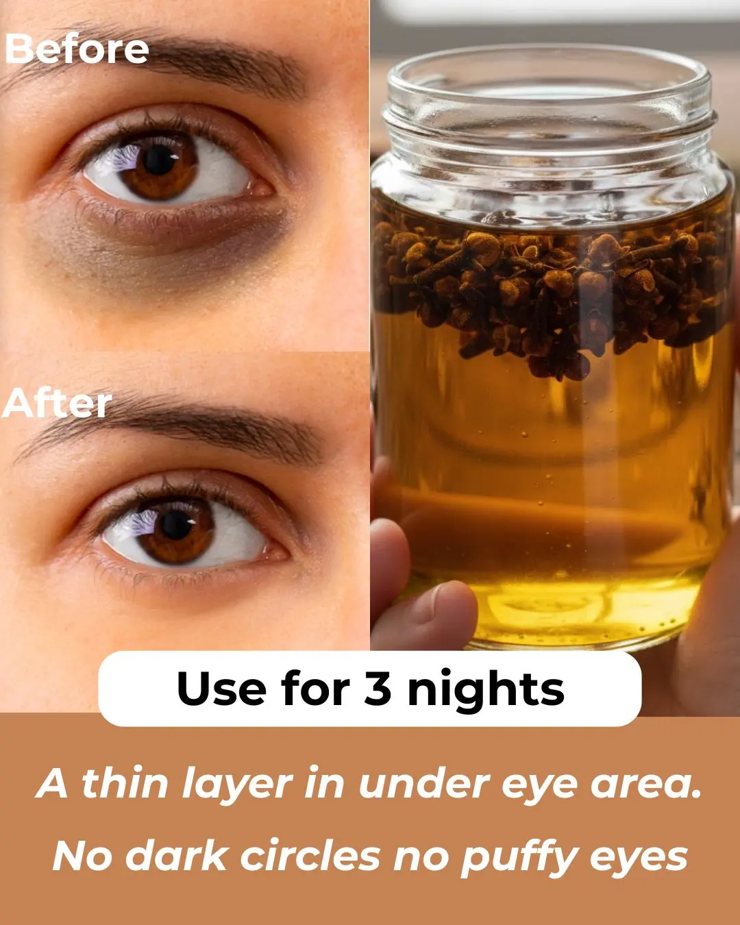 Treat Dark Circles, Sunken Eyes & Puffy Eyes with Home Remedies and Eye Creams
