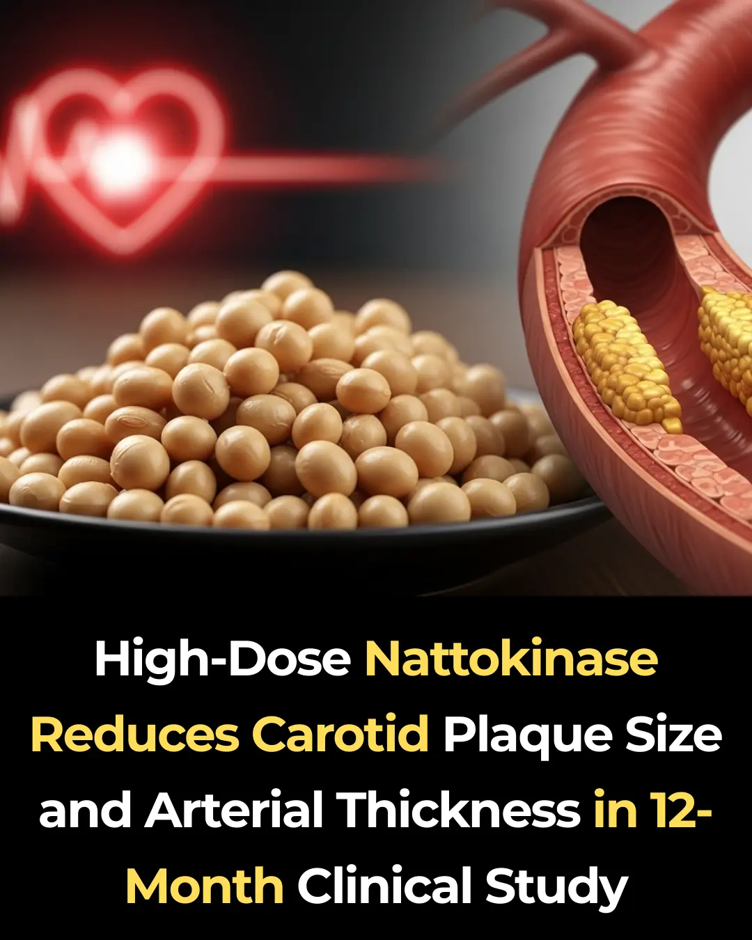 High-Dose Nattokinase Reduces Carotid Plaque Size and Arterial Thickness in 12-Month Clinical Study