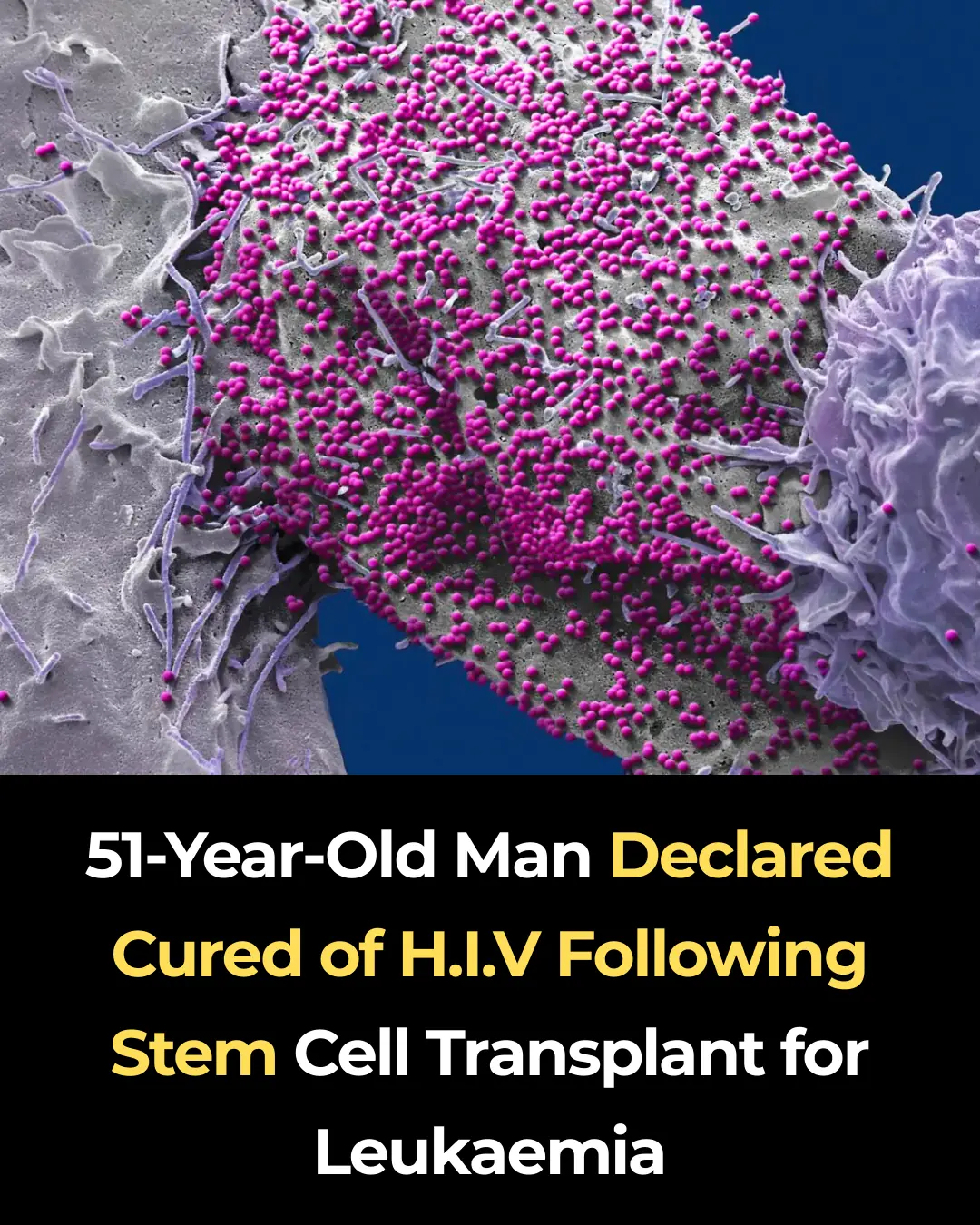 51-Year-Old Man Declared Cured of HIV Following Stem Cell Transplant for Leukaemia