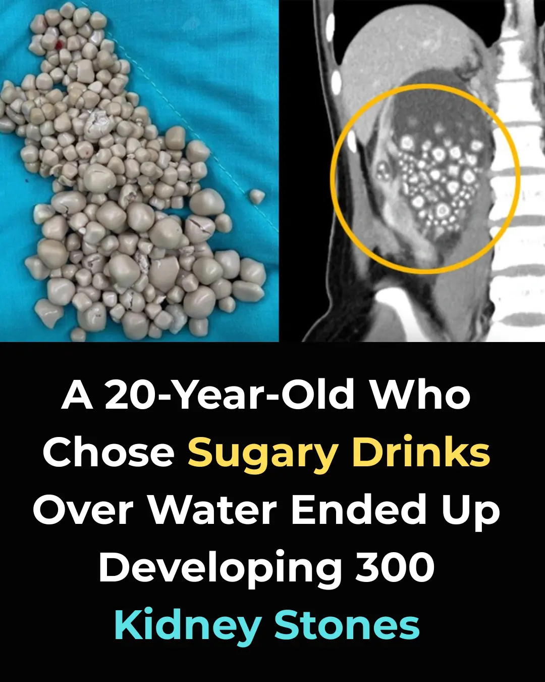 She Drank Bubble Tea Every Day — What Happened to Her Kidneys Will Shock You