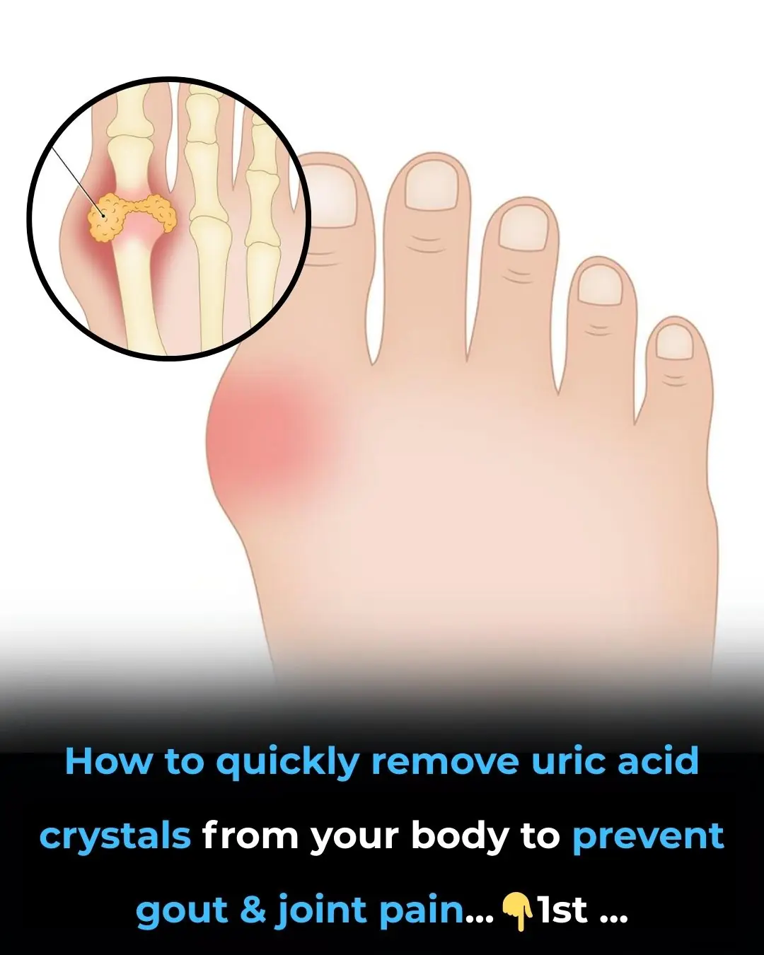 How to Reduce Uric Acid Crystals Naturally and Lower the Risk of Gout and Joint Pain