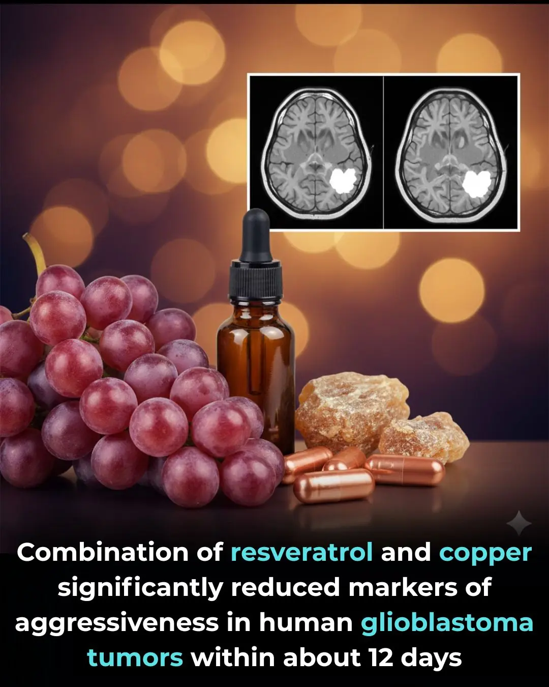 Combination of resveratrol and copper significantly reduced markers of aggressiveness in human glioblastoma tumors within about 12 days.