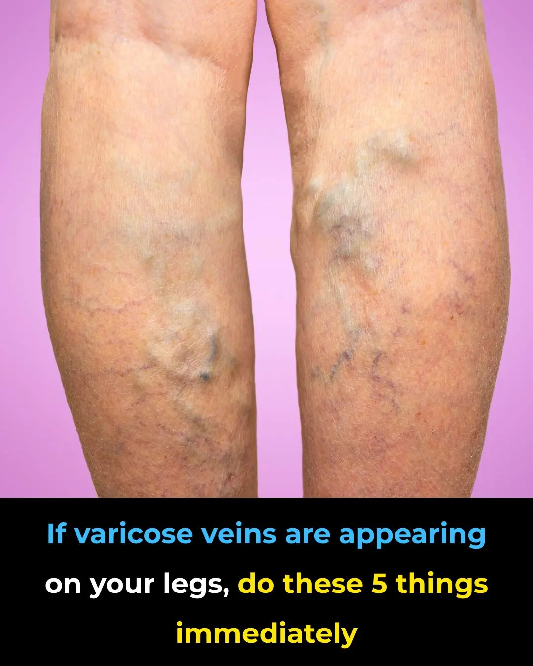 14 Tips to Improve Varicose Veins Naturally + The Best Essential Oils for Varicose Veins